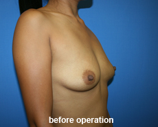 plastic-surgery-breast-augmentation